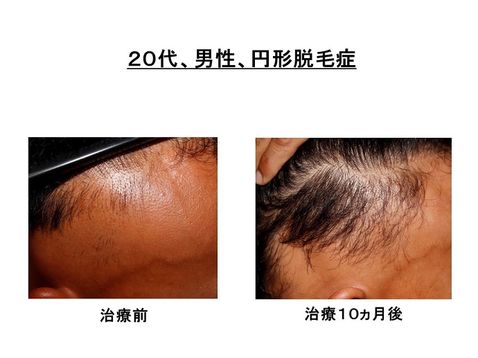 円形脱毛症　病院